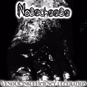 Venous Insufficiency Ulceration By Nosecheese 